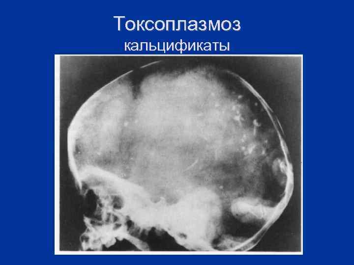 Токсоплазмоз кальцификаты 