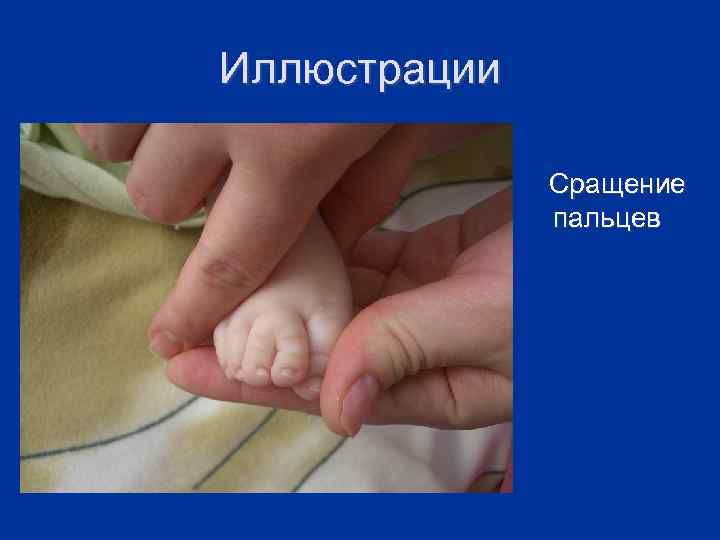 Иллюстрации Сращение пальцев 