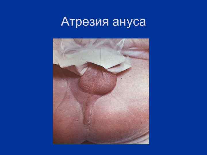 Атрезия ануса 
