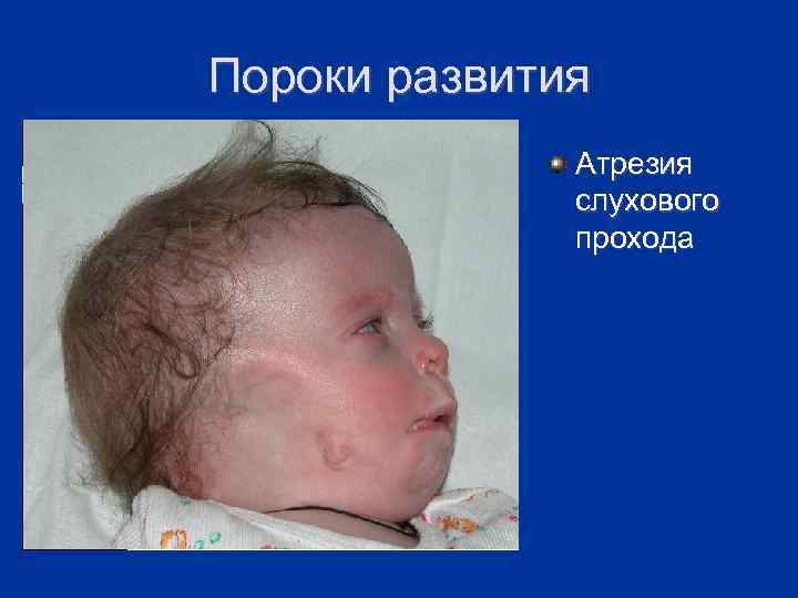 Пороки развития Атрезия слухового прохода 
