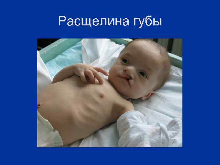 Расщелина губы 