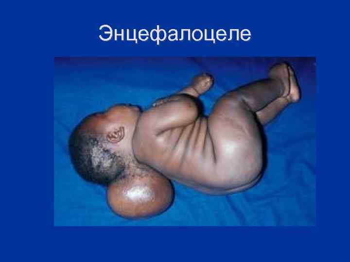 Энцефалоцеле 
