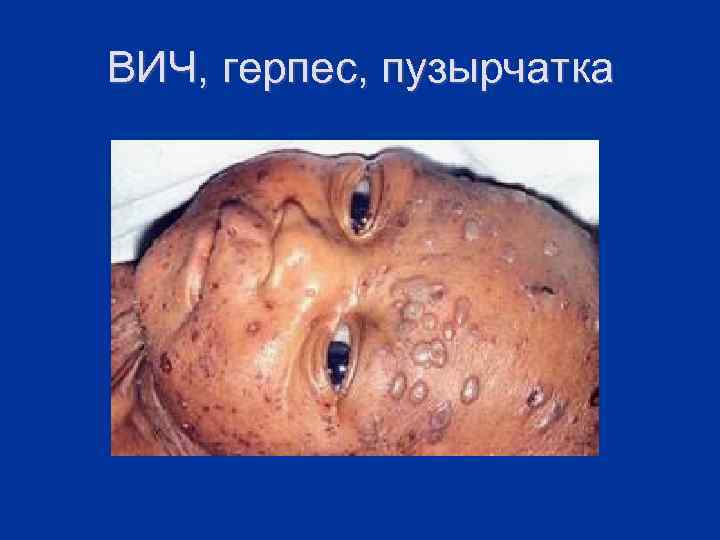 ВИЧ, герпес, пузырчатка 