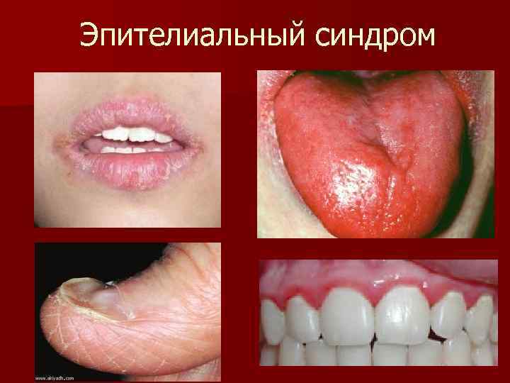 Эпителиальный синдром 