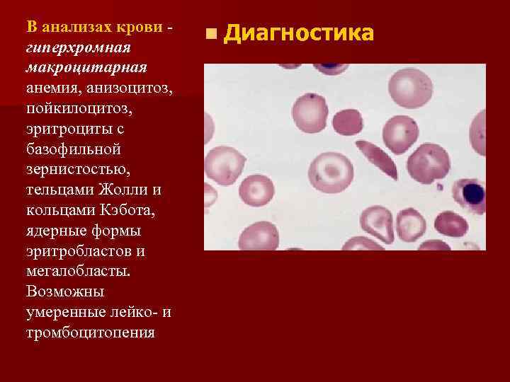 Анизоцитоз эритроцитов. Анизоцитоз, пойкилоцитоз, тельца Жолли, кольца Кебота. Анизоцитоз пойкилоцитоз базофильная зернистость эритроцитов. Анизоцитоз и пойкилоцитоз при анемии.