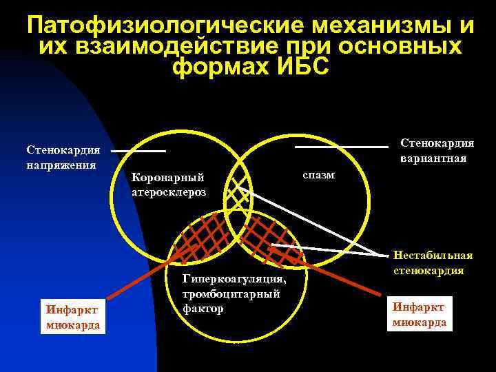 Патофизиологические механизмы и их взаимодействие при основных формах ИБС Стенокардия напряжения Инфаркт миокарда Стенокардия
