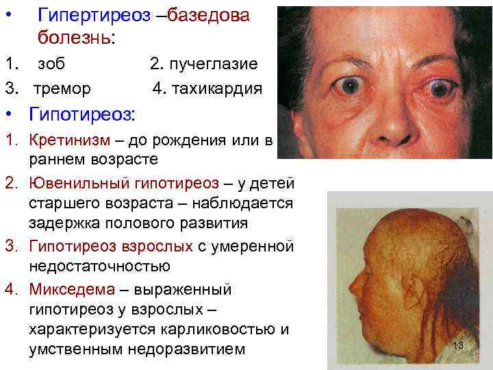  • Гипертиреоз –базедова болезнь: 1. зоб 3. тремор 2. пучеглазие 4. тахикардия •