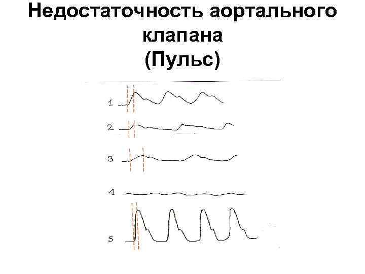 Недостаточность аортального клапана (Пульс) 