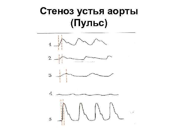 Стеноз устья аорты (Пульс) 