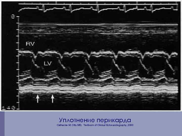 Уплотнение перикарда Catherine M. Otto MD, Textbook of Clinical Echocardiography, 2000 