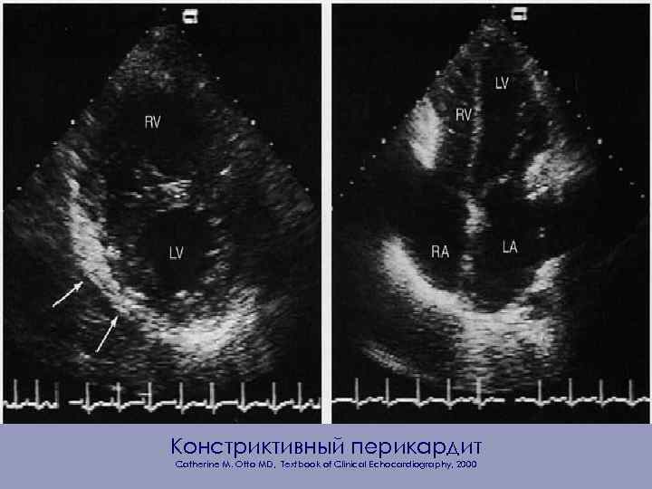 Констриктивный перикардит Catherine M. Otto MD, Textbook of Clinical Echocardiography, 2000 