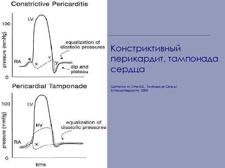 Констриктивный перикардит, тампонада сердца Catherine M. Otto MD, Textbook of Clinical Echocardiography, 2000 