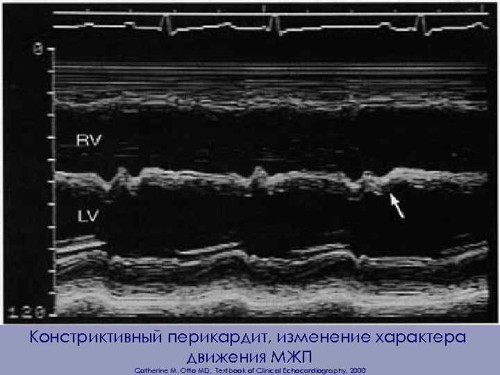 Констриктивный перикардит, изменение характера движения МЖП Catherine M. Otto MD, Textbook of Clinical Echocardiography,