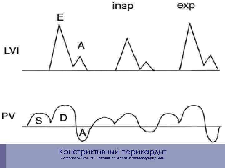 Констриктивный перикардит Catherine M. Otto MD, Textbook of Clinical Echocardiography, 2000 