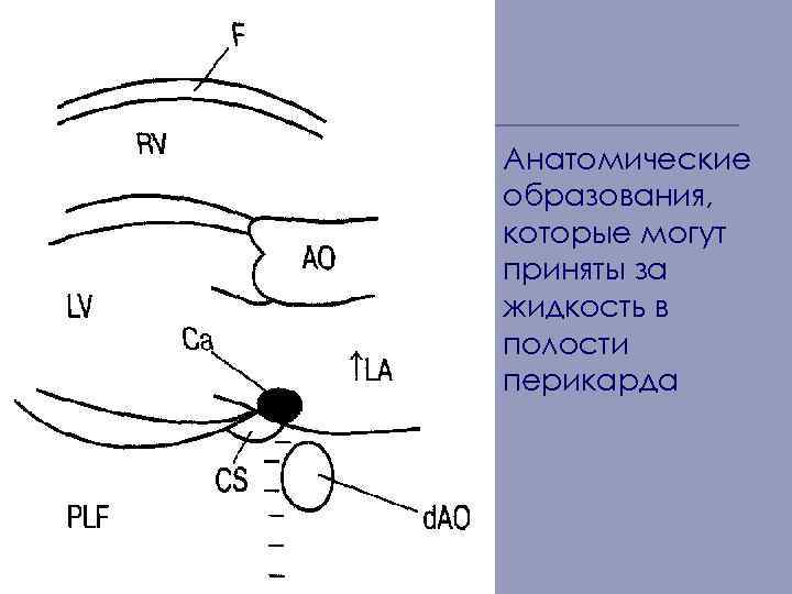 Анатомические образования, которые могут приняты за жидкость в полости перикарда 