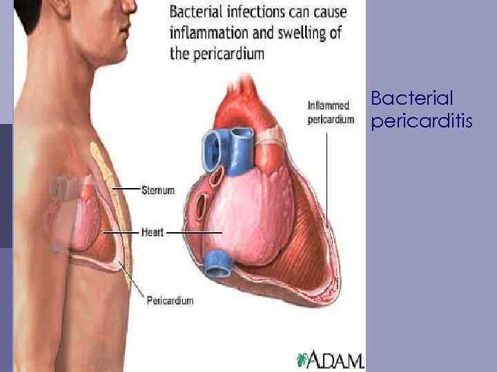 Bacterial pericarditis 