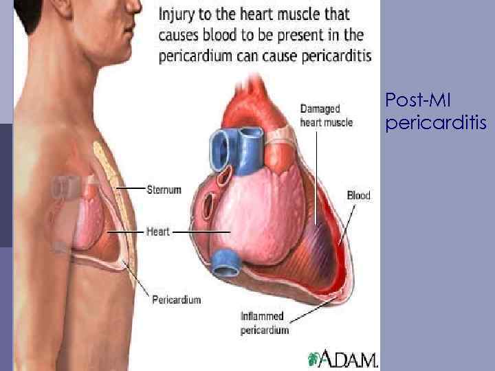 Post-MI pericarditis 