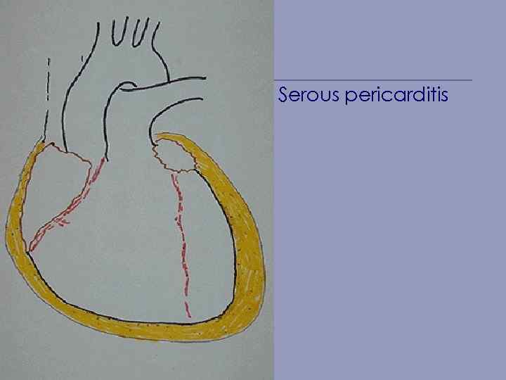 Serous pericarditis 