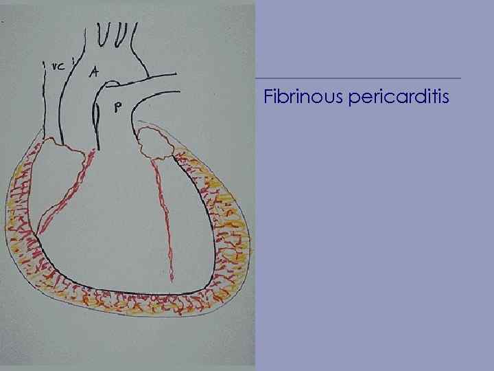 Fibrinous pericarditis 