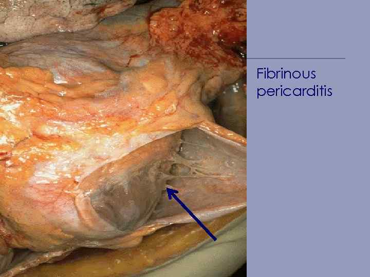 Fibrinous pericarditis 