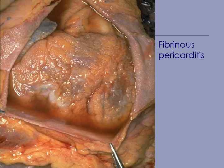 Fibrinous pericarditis 