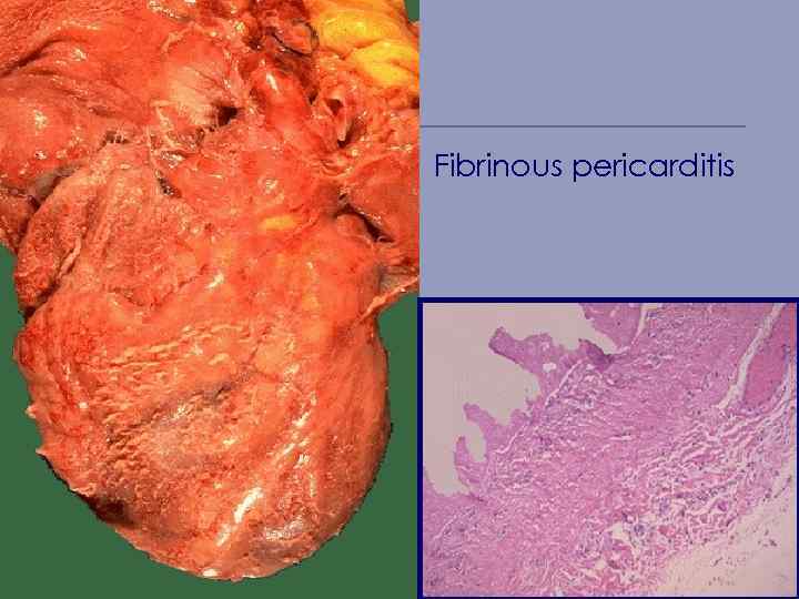 Fibrinous pericarditis 