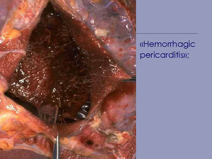  «Hemorrhagic рericarditis» ; 