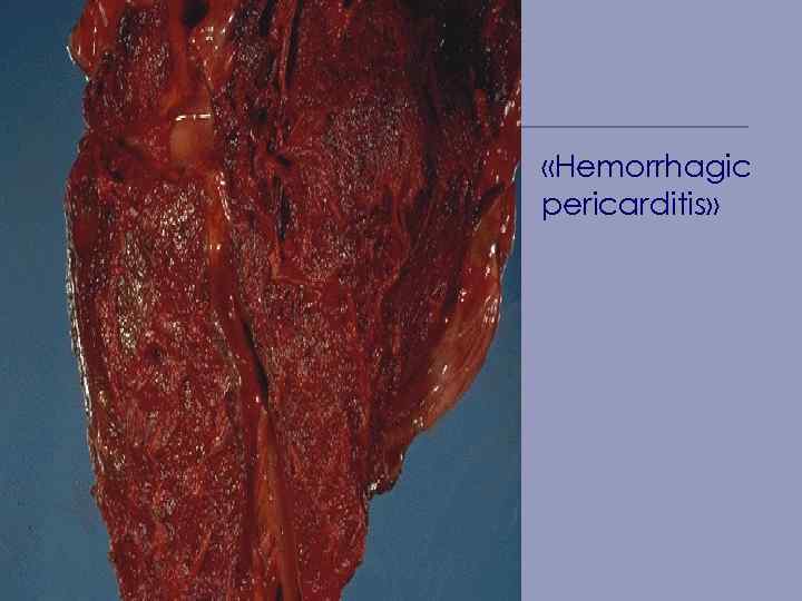  «Hemorrhagic pericarditis» 