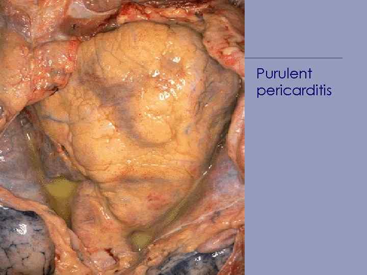 Purulent pericarditis 