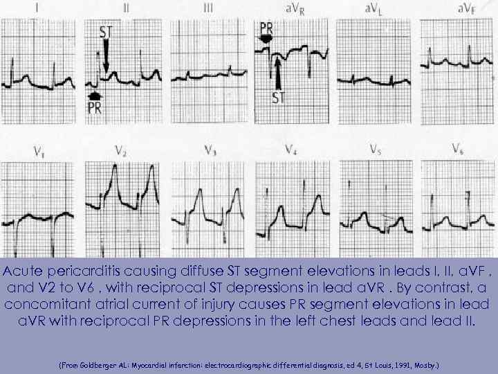 Acute pericarditis causing diffuse ST segment elevations in leads I, II, a. VF ,