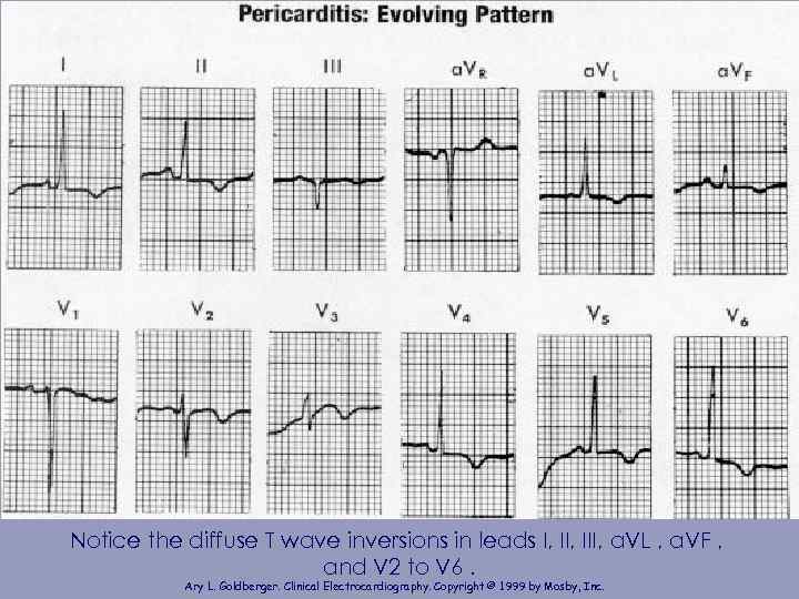 Notice the diffuse T wave inversions in leads I, III, a. VL , a.