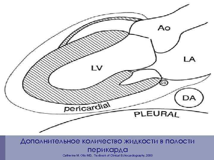 Дополнительное количество жидкости в полости перикарда Catherine M. Otto MD, Textbook of Clinical Echocardiography,