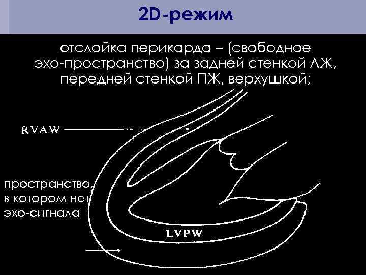 2 D-режим отслойка перикарда – (свободное эхо-пространство) за задней стенкой ЛЖ, передней стенкой ПЖ,