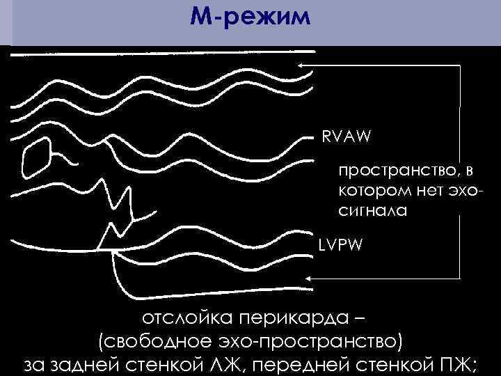 M-режим RVAW пространство, в котором нет эхосигнала LVPW отслойка перикарда – (свободное эхо-пространство) за