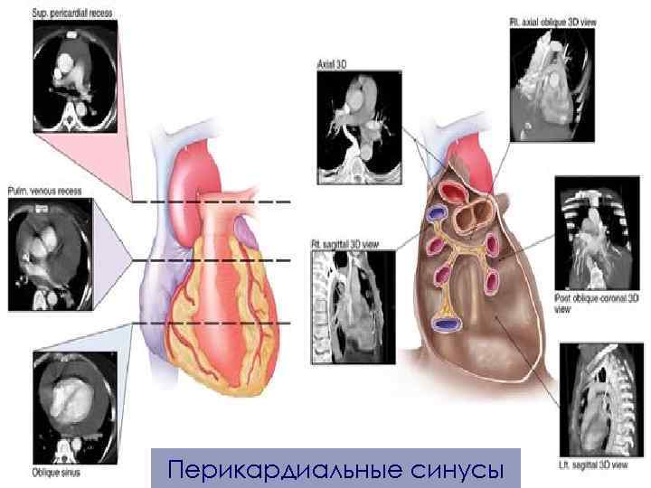 Перикардиальные синусы 