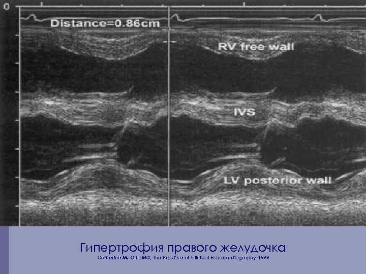 Гипертрофия правого желудочка Catherine M. Otto MD, The Practice of Clinical Echocardiography, 1999 