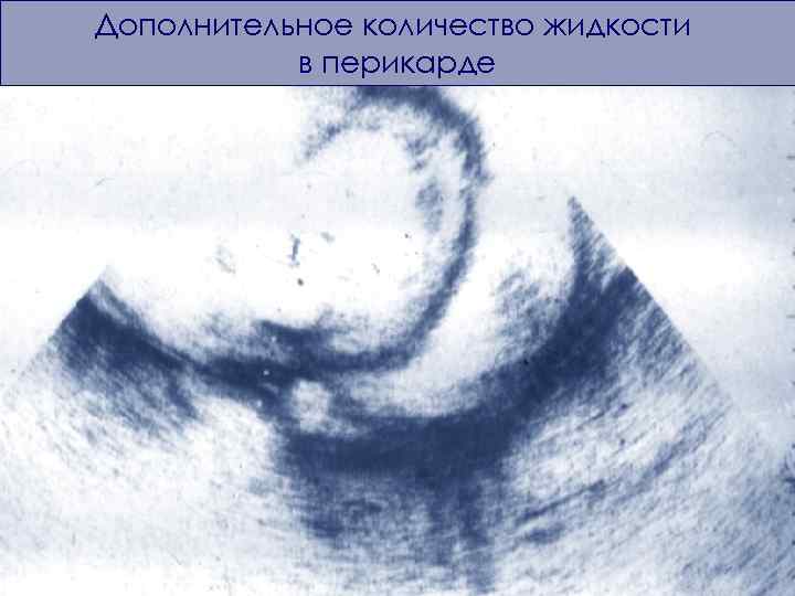 Дополнительное количество жидкости в перикарде 