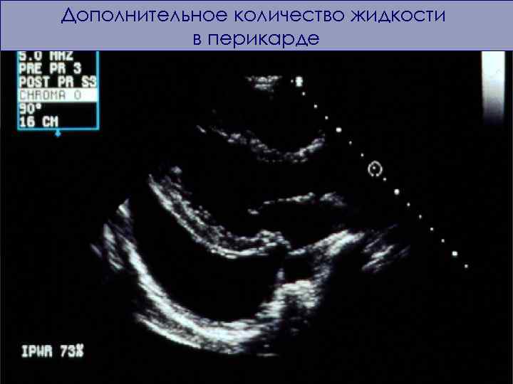 Дополнительное количество жидкости в перикарде 