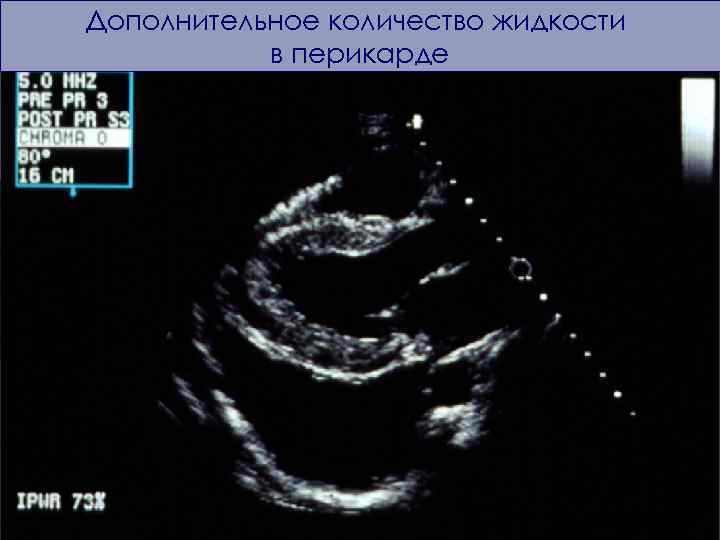 Дополнительное количество жидкости в перикарде 