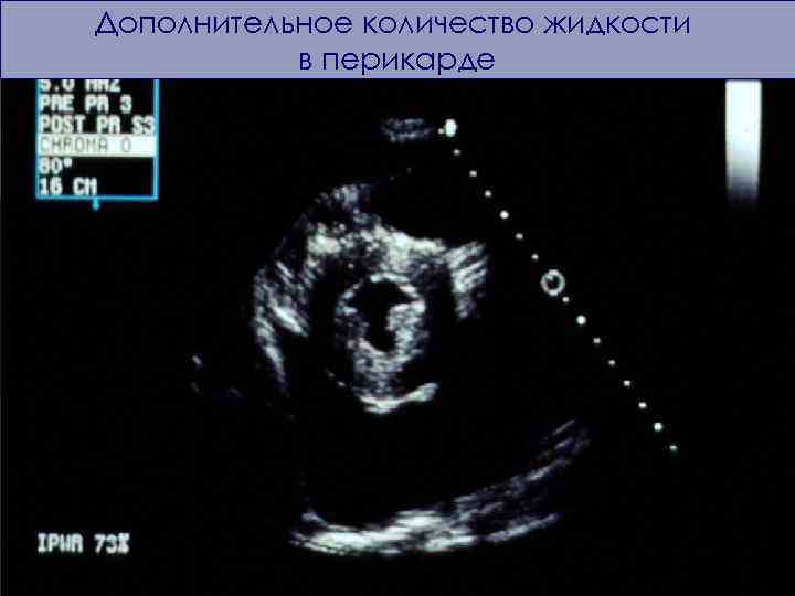 Дополнительное количество жидкости в перикарде 