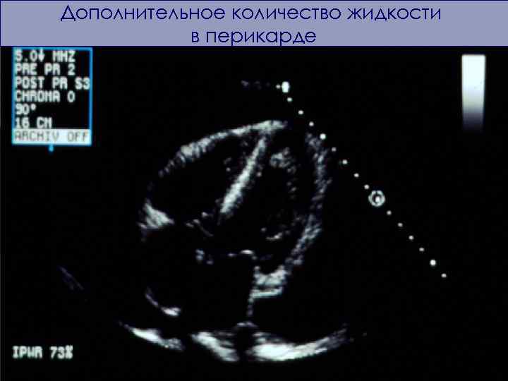 Дополнительное количество жидкости в перикарде 