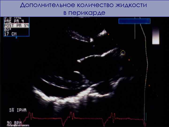 Дополнительное количество жидкости в перикарде 