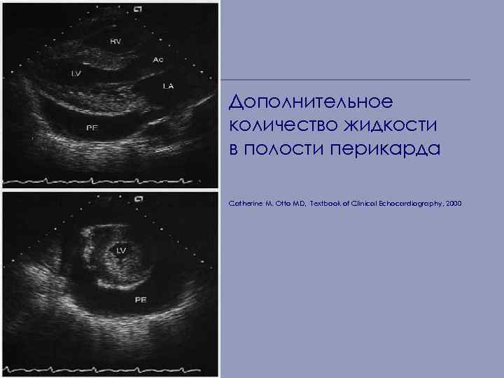 Дополнительное количество жидкости в полости перикарда Catherine M. Otto MD, Textbook of Clinical Echocardiography,