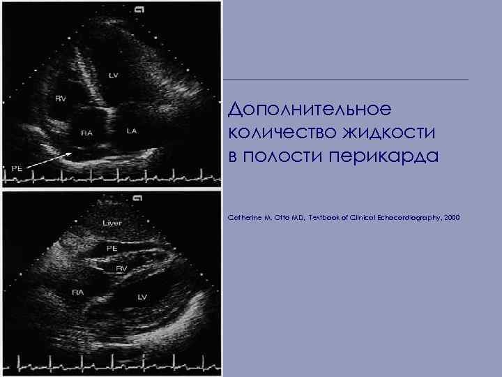 Дополнительное количество жидкости в полости перикарда Catherine M. Otto MD, Textbook of Clinical Echocardiography,