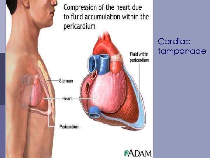 Cardiac tamponade 