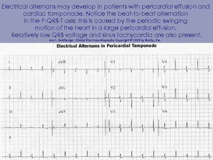 Electrical alternans may develop in patients with pericardial effusion and cardiac tamponade. Notice the