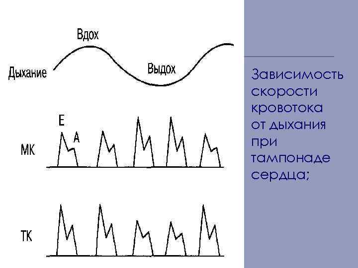 Зависимость скорости кровотока от дыхания при тампонаде сердца; 