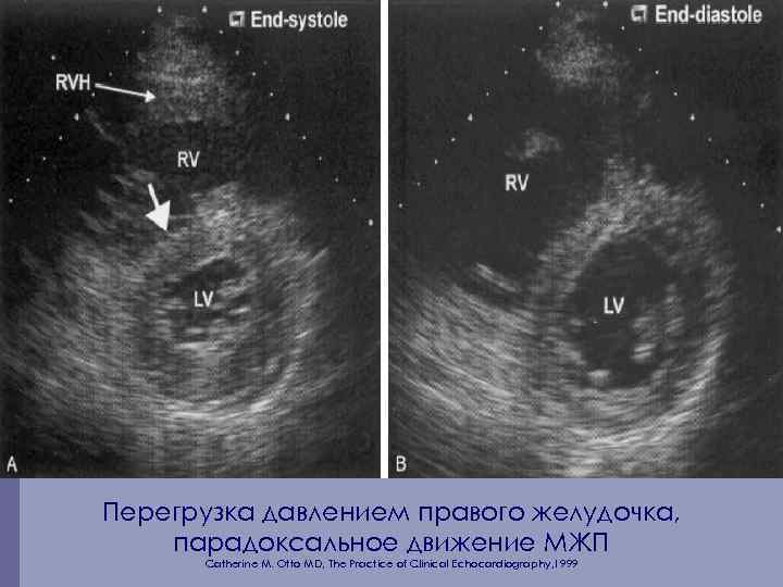 Перегрузка давлением правого желудочка, парадоксальное движение МЖП Catherine M. Otto MD, The Practice of