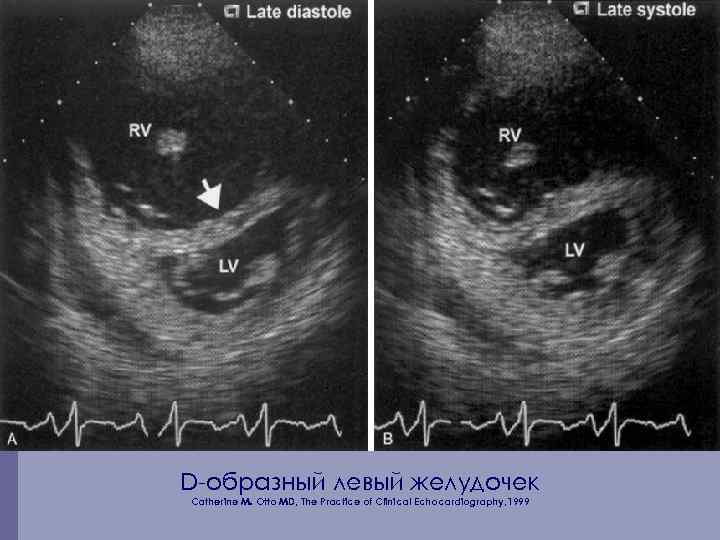 D-образный левый желудочек Catherine M. Otto MD, The Practice of Clinical Echocardiography, 1999 