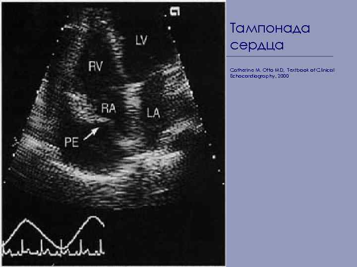 Тампонада сердца Catherine M. Otto MD, Textbook of Clinical Echocardiography, 2000 